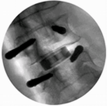 Image: The Valeo VBR ceramic spinal implant in situ (Photo courtesy of Amedica). Image: The Valeo VBR ceramic spinal implant in situ (Photo courtesy of Amedica).